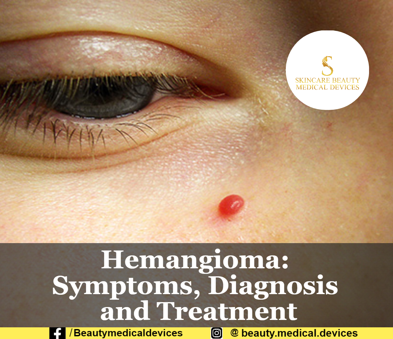 Hemangioma Symptoms, Diagnosis and Treatment