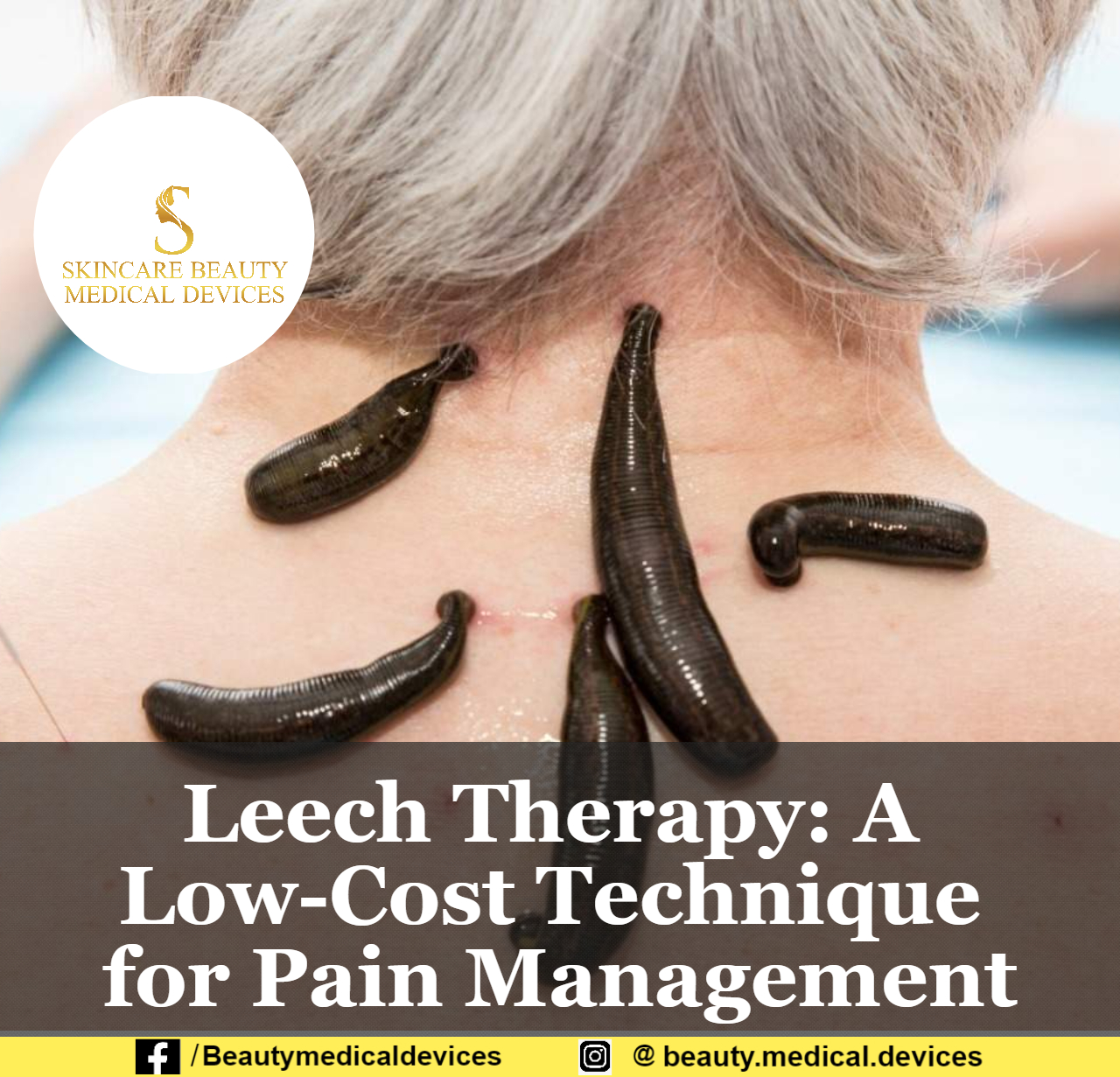 Leech Therapy A LowCost Technique for Pain Management