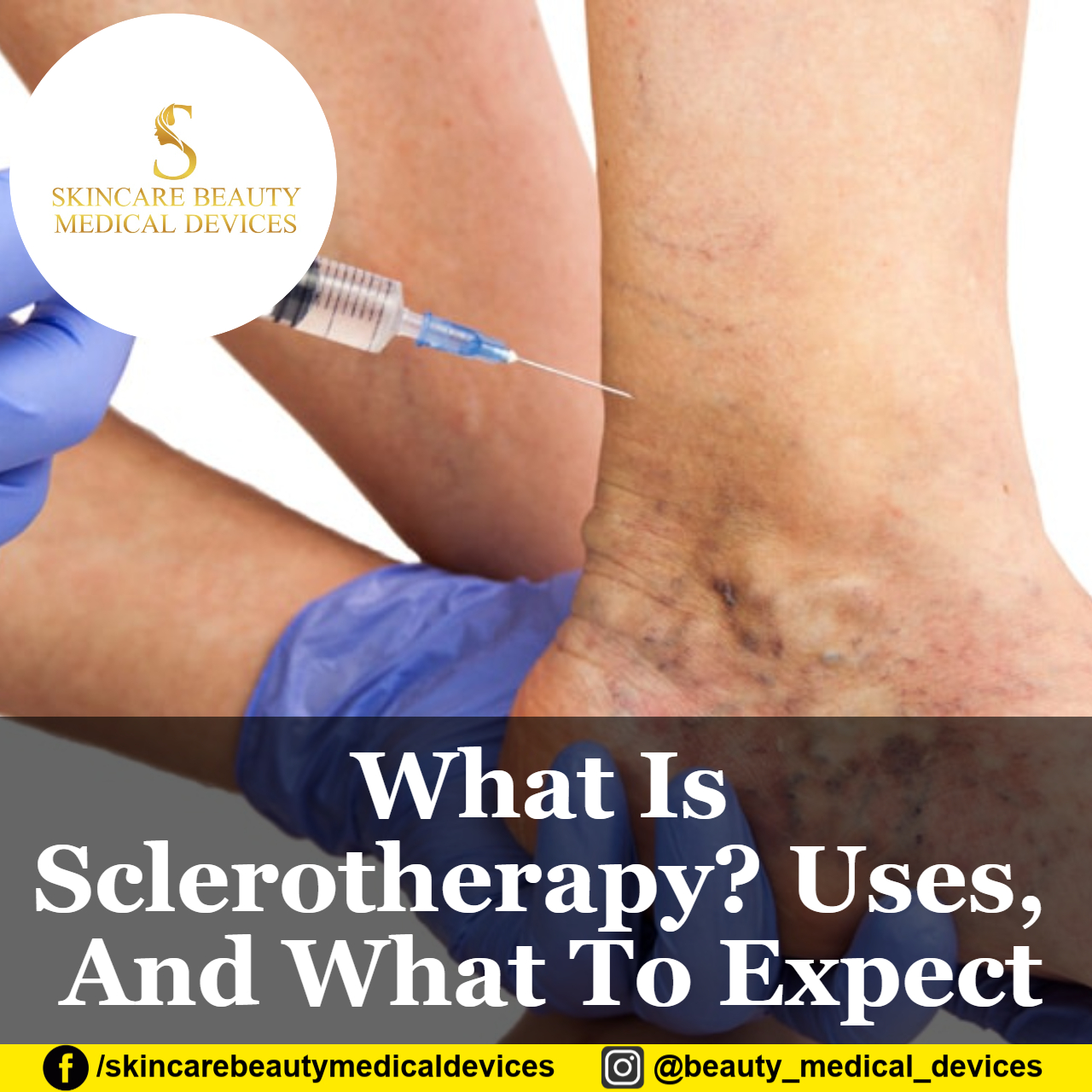 What Is Sclerotherapy? Uses, And What To Expect