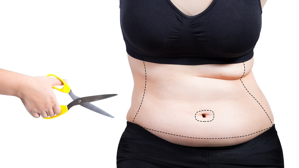 SmartLipo Poland Smart liposuction abroad price, reviews, before