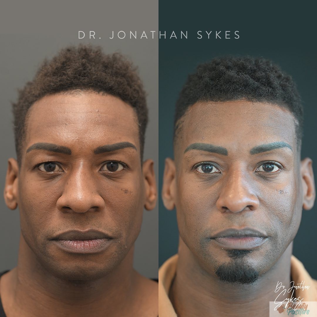 Comprehensive Guide to Liposuction Costs