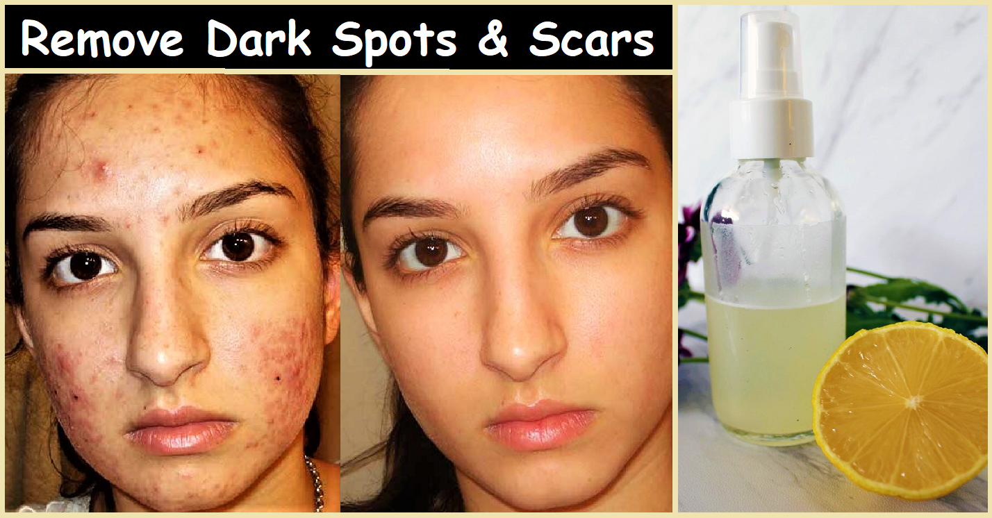 Best Essential oils to remove Dark Spots & Glowing Skin