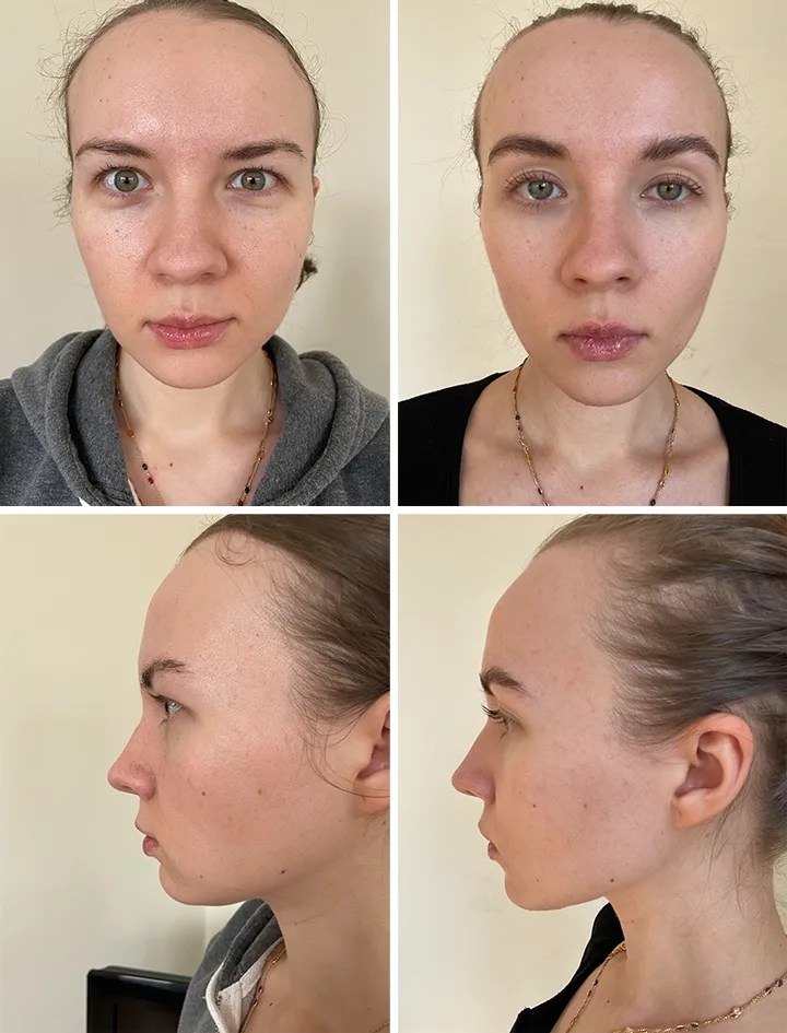 Microcurrent Facial Reviews Benefits, SideEffects & Devices