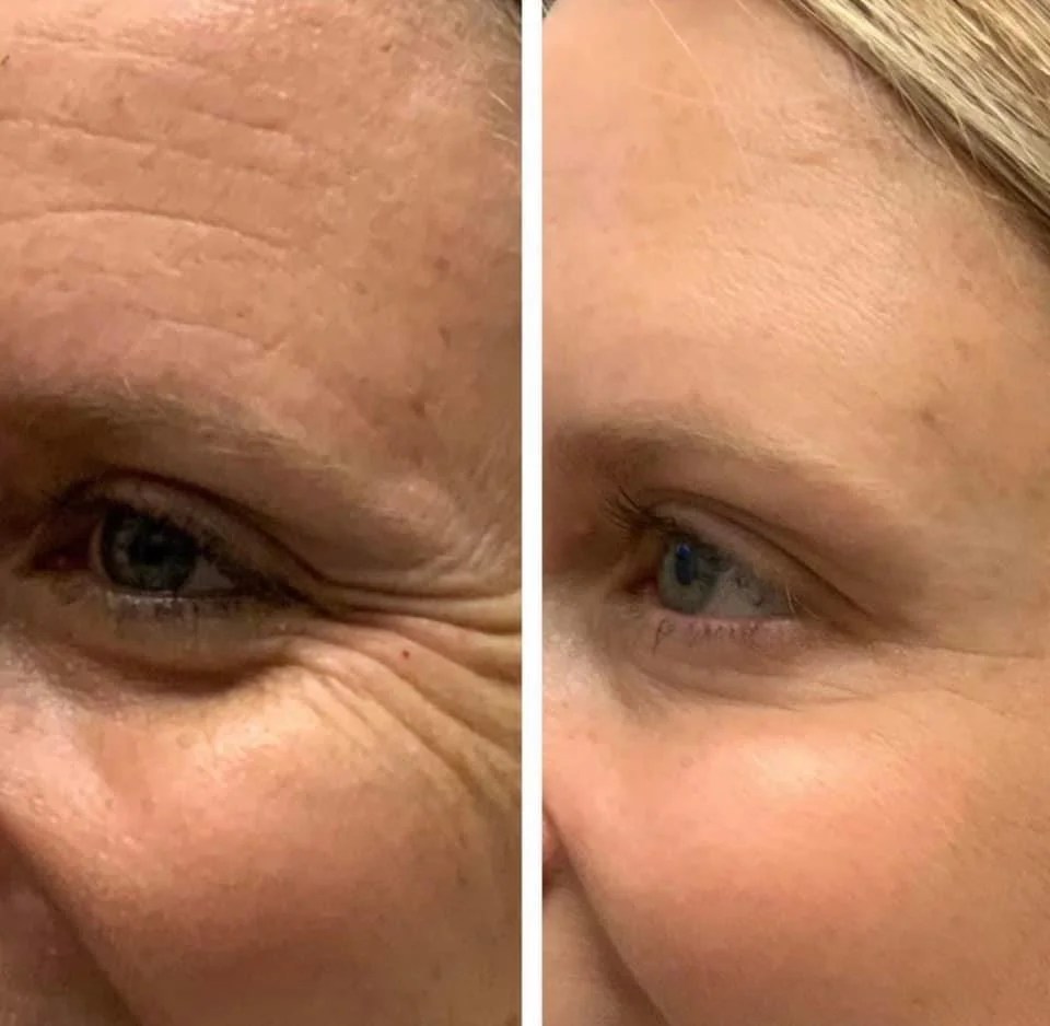 Botox/Dysport/Xeomin/Daxxify BeautyWoRX Bardstown