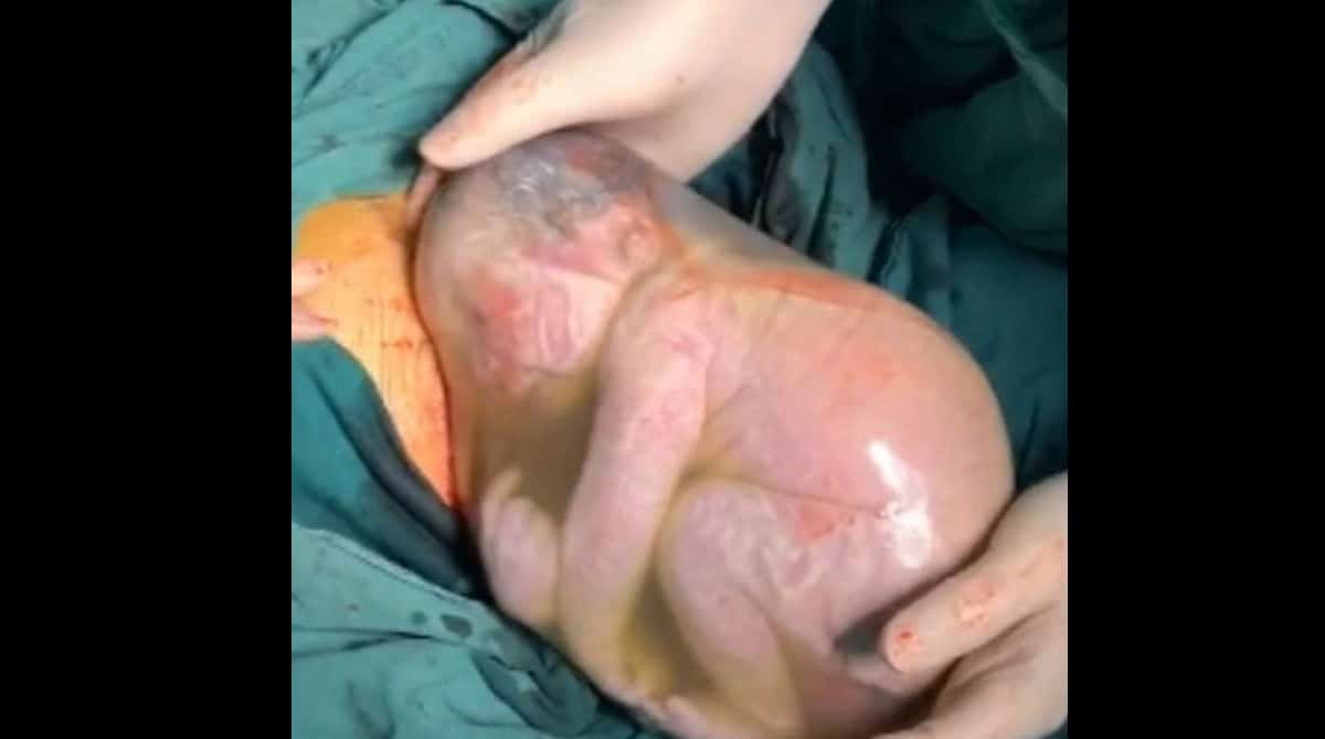 Bebê nasce dentro do saco amniótico e fica dois minutos