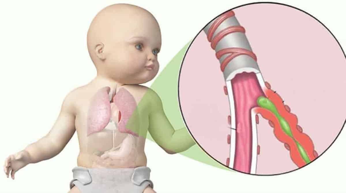Bronquiolite em bebês o que é, como prevenir e tratar Bebê Mamãe
