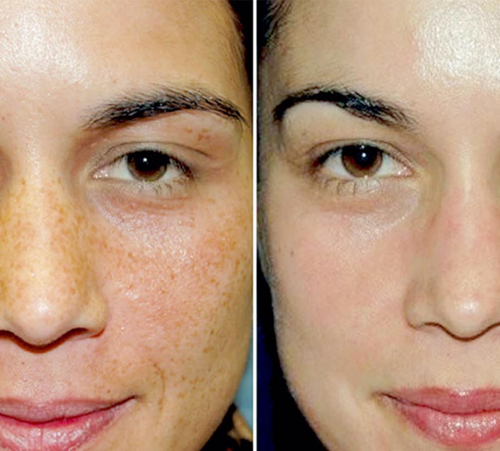 Best VI Peel Near Me VI Peel Precision Plus Houston, TX