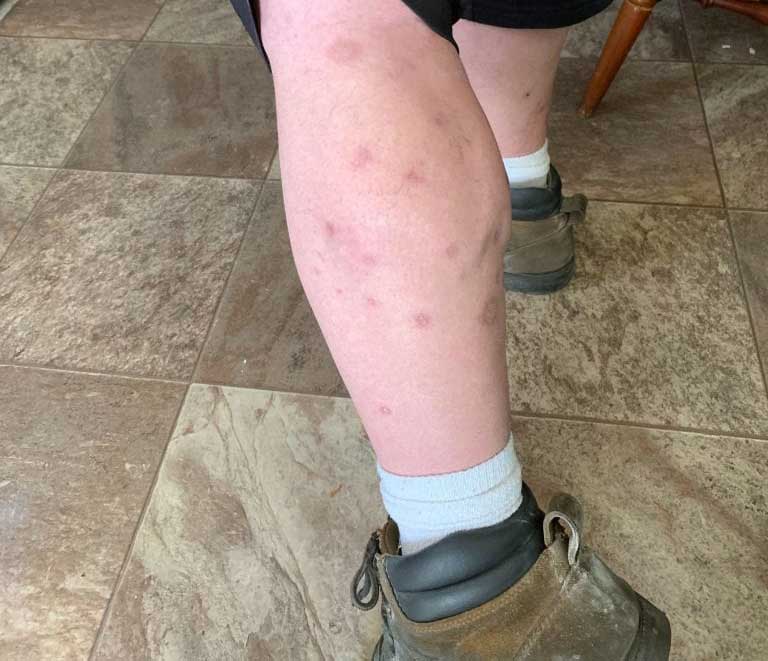 How to Properly Treat Bed Bug Bites Bed Bug Cleveland, Ohio Bed Bug