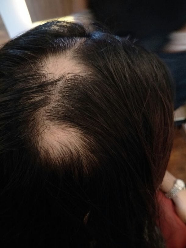 Suffering from Alopecia, Hair loss ? Natural Herbal