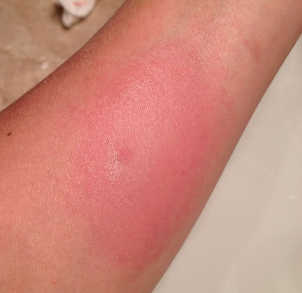 Top 32+ Images show me a picture of a bee sting Full HD, 2k, 4k
