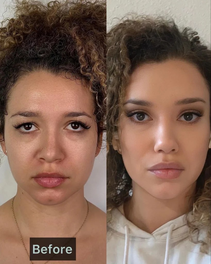 Facelift Before and After Before After Journey