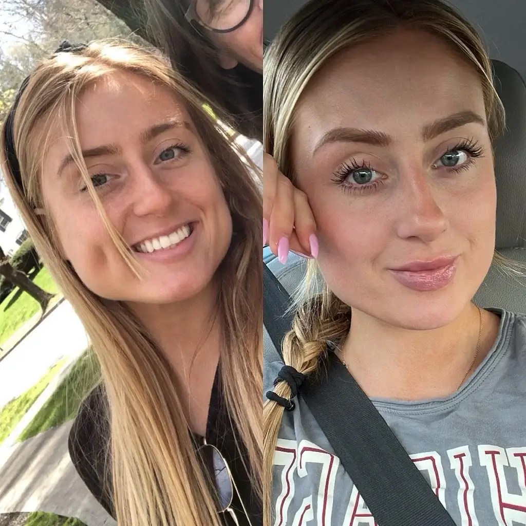 Masseter Botox Before and After Before After Journey