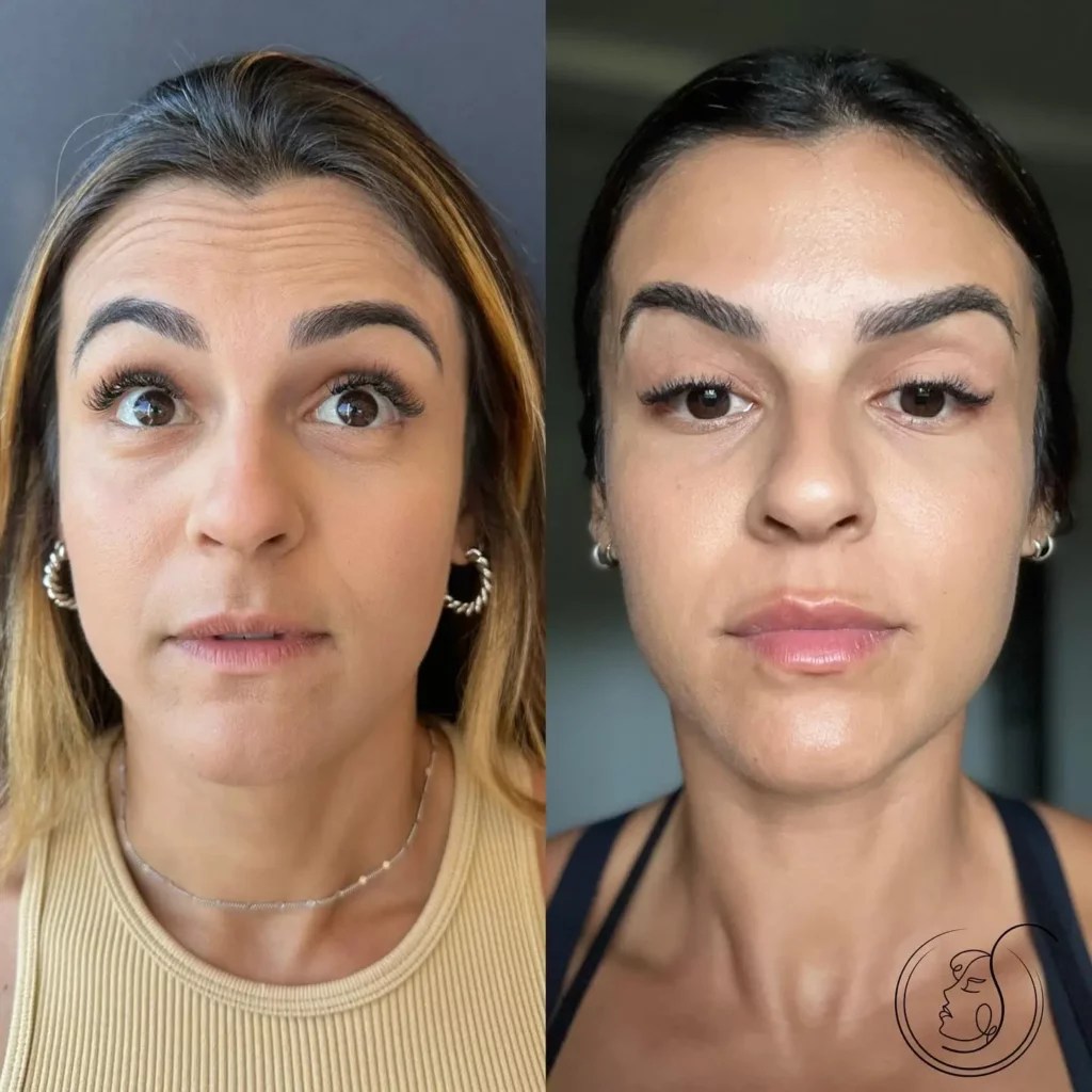Botox Before and After Before After Journey