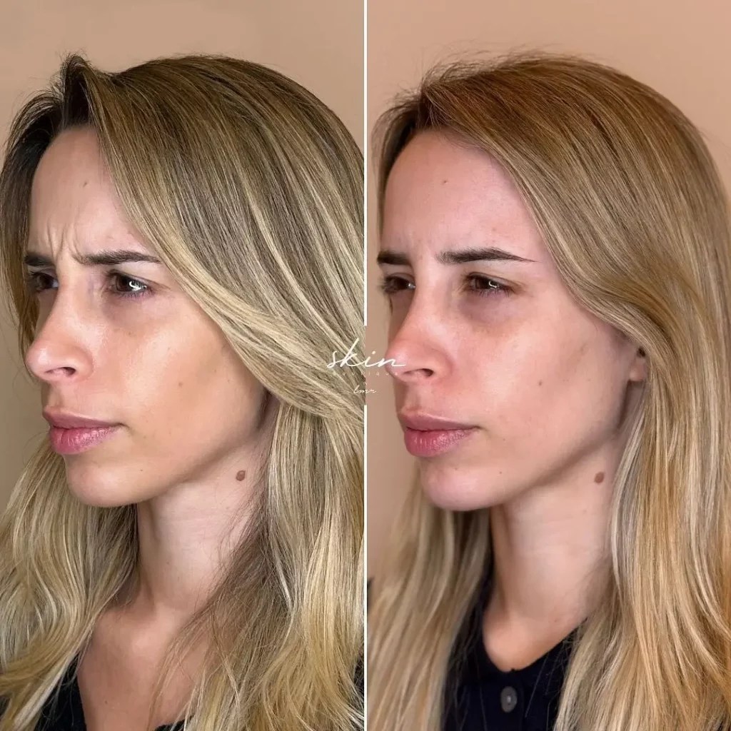 Botox Before and After Before After Journey(04)