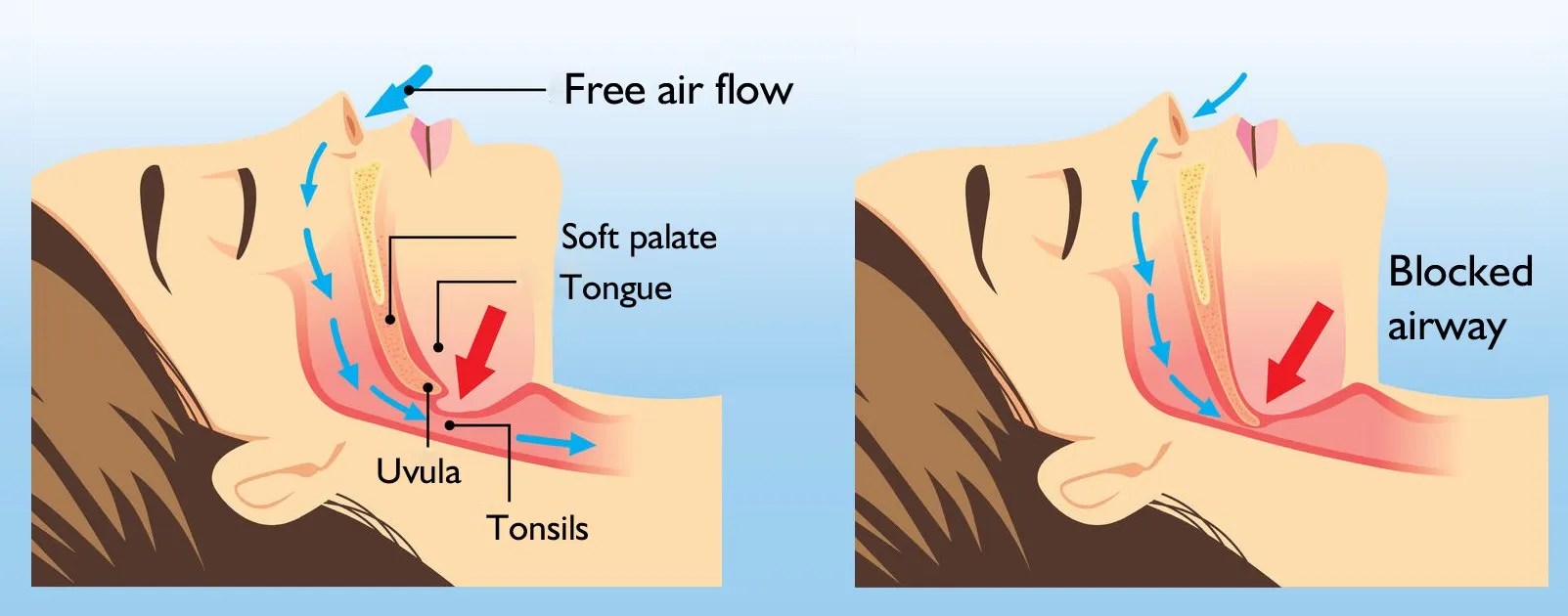 The 1 Best Nasal Strips For Snoring & Better Sleep