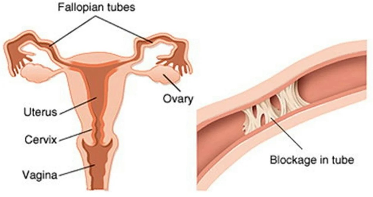 How to Get Rid of Blocked Fallopian Tubes