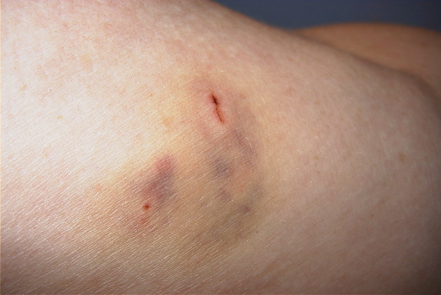 A Dog bit me, What should I do? BeingTheDoctor