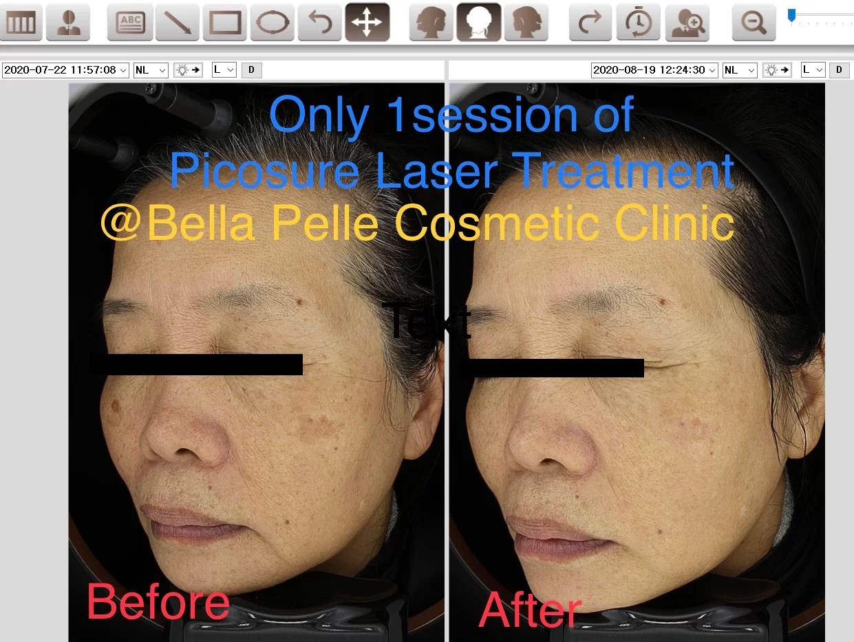 Picosure Laser Treatments Bella Pelle Cosmetic Clinic