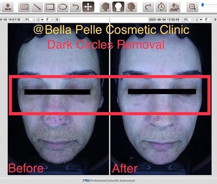 1 Dark Circles Treatment Clinic In Sydney Bella Pelle CC
