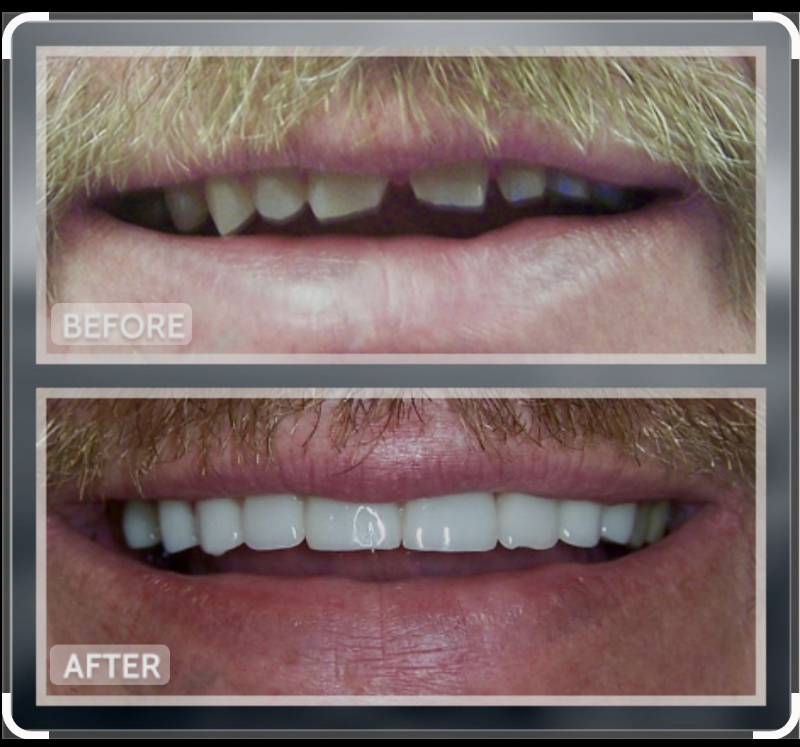 Implant Dentist Pasadena Pasadena Implant Dentist