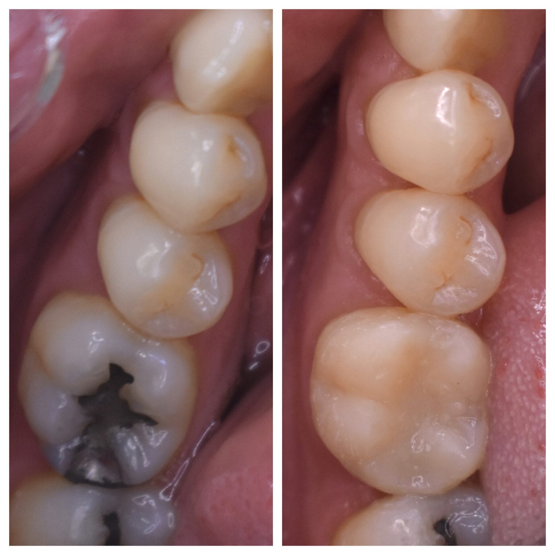 Fillings Belleview Dental