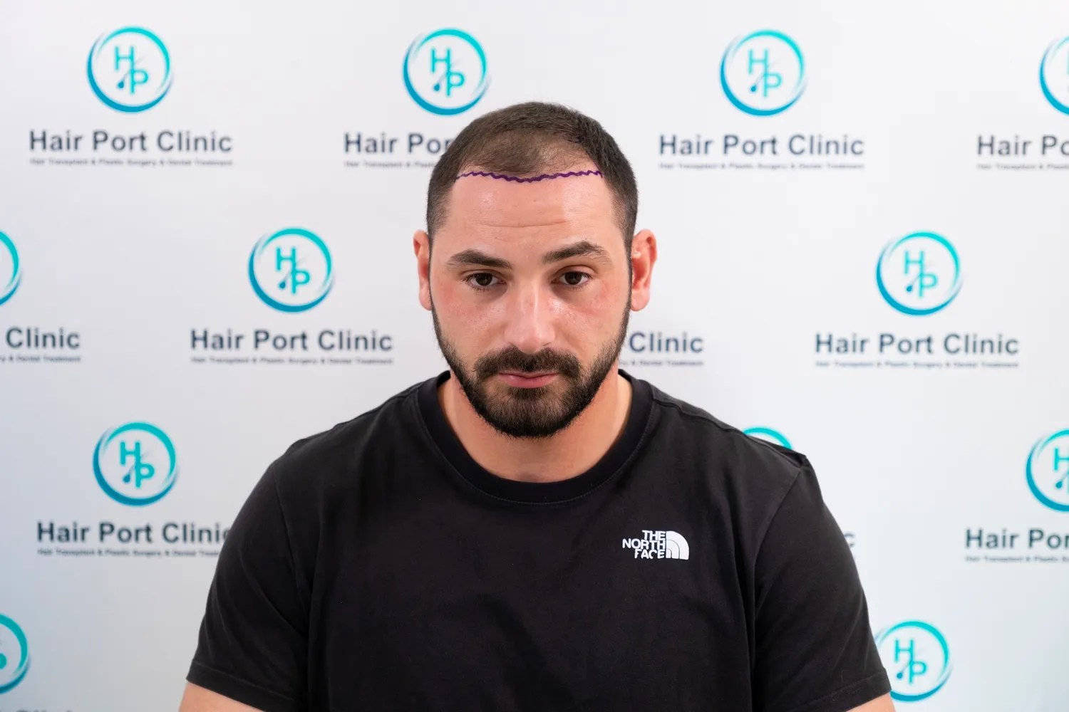 CASO HAIRPORT CLINIC 5000 GRAFTS FUE Bellicapelli Forum