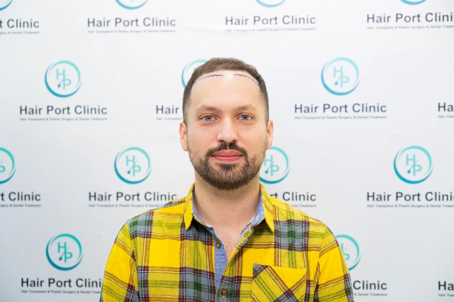 CASO HAIRPORT CLINIC 4000 GRAFTS FUE Bellicapelli Forum