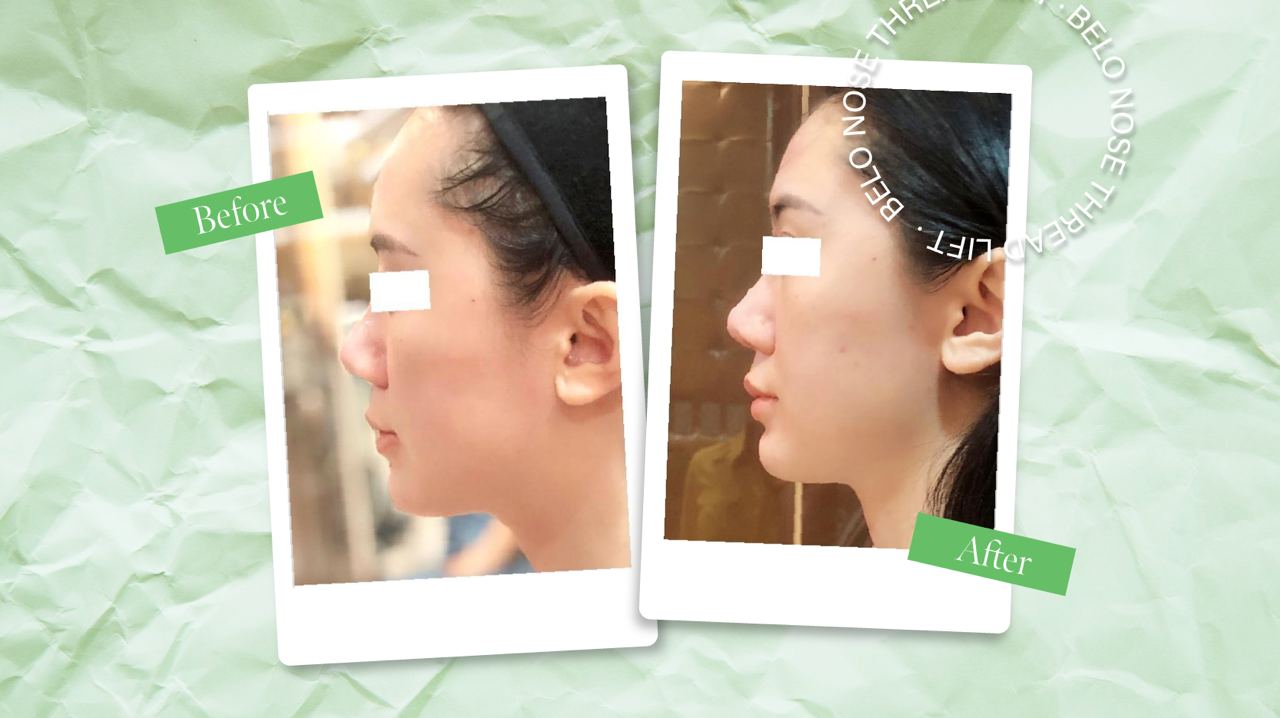 Everything You Need to Know About Nose Thread Lifts