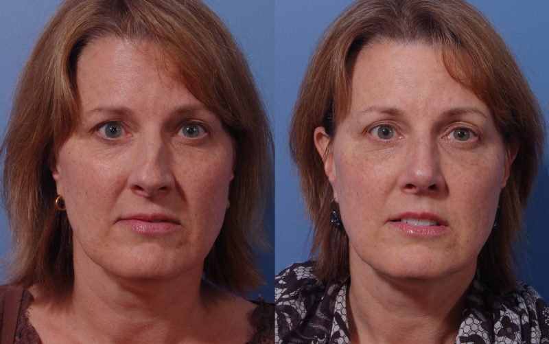 BellevueSeattle Rhinoplasty Surgical Nose Job Surgery in Seattle, WA