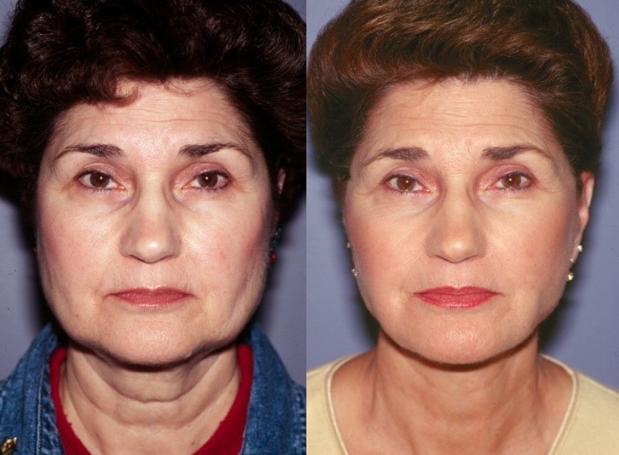 Bellevue Facelift Seattle MiniFacelift, Cheek Lift & Neck Lift Surgery