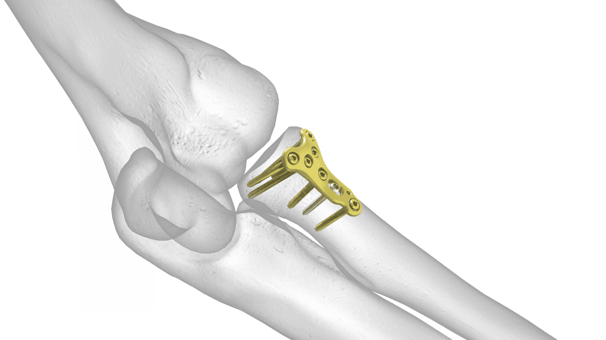 Radial Head plates BeMedico
