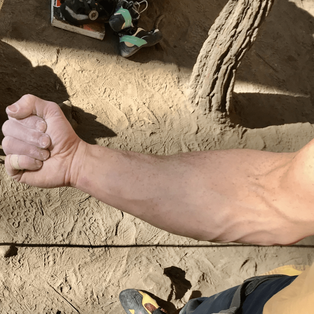 Medial Epicondyle Tendinopathy In Climbing Bend + Mend Physiotherapy