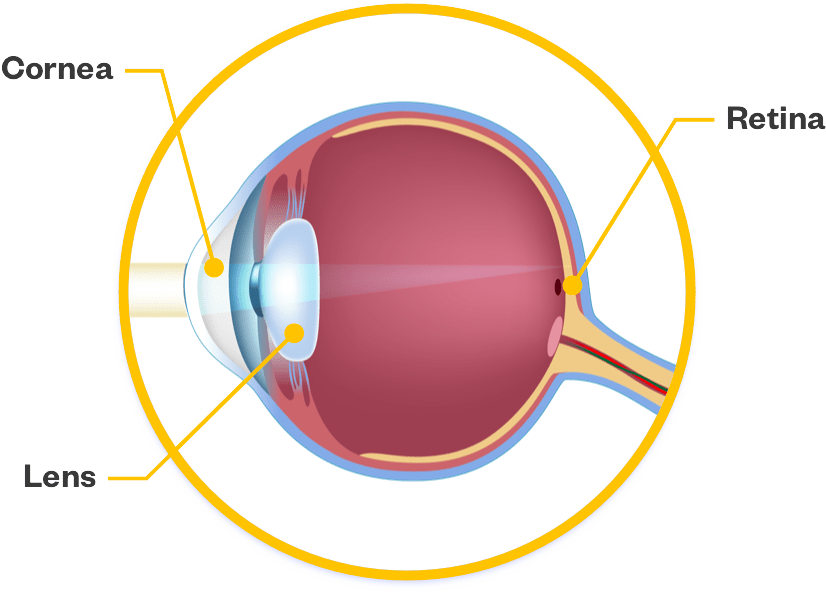 Cataract Surgery Bense Mceachren Cataract Centre