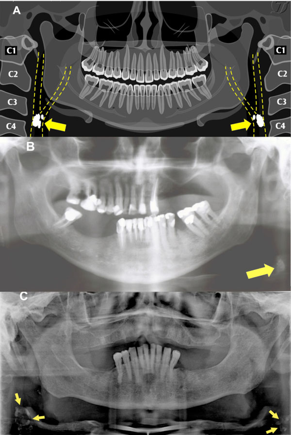 Panoramic Radiography in the Diagnosis of Carotid Artery Atheromas and