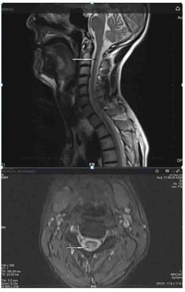 Vitamin B12 Deficiency as a Cause of Neurotrophic Keratopathy Fulltext