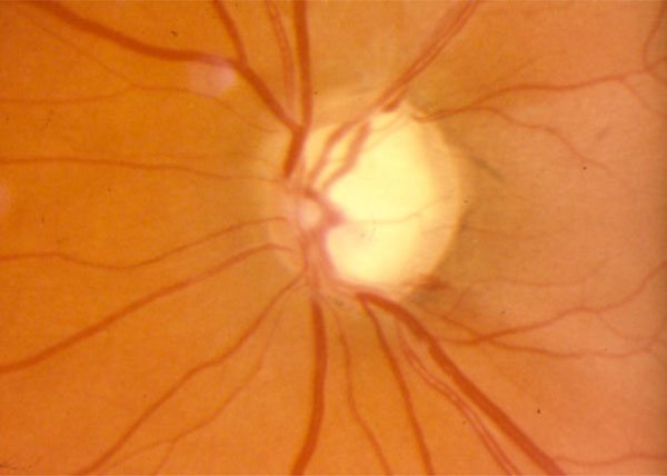Evaluating Optic Nerve Damage Pearls and Pitfalls Fulltext