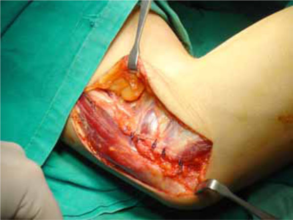 Ulnar Nerve Dislocation at the Elbow Review of the Literature and