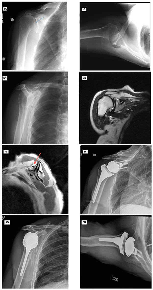 Irreparable Rotator Cuff Tears Without Arthritis Treated With Reverse