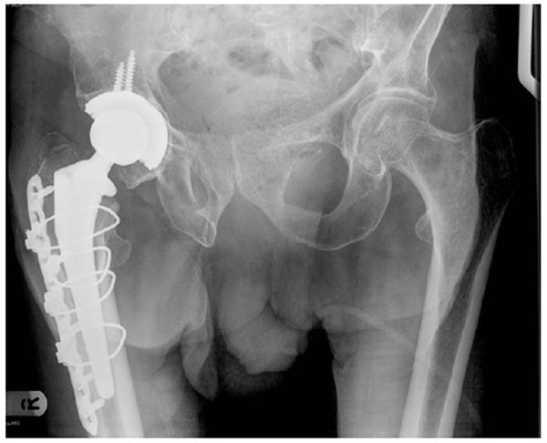 Combined Intracapsular And Extracapsular Neck Of Femur