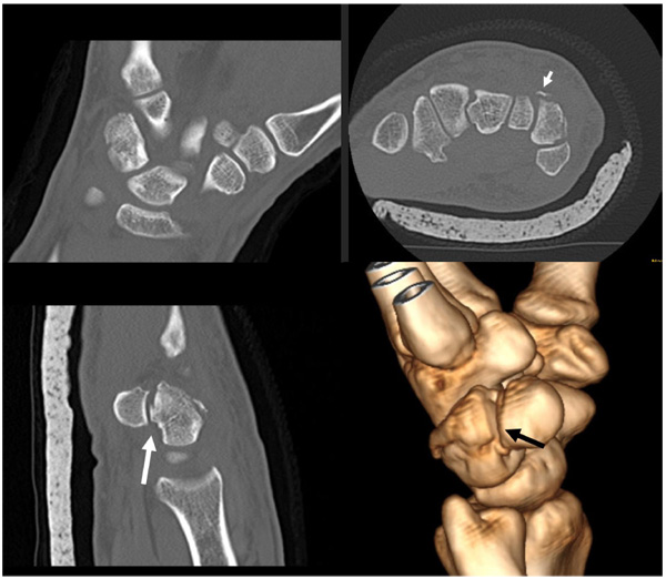 Intraarticular Fracture of the Distal part of the Triquetrum within