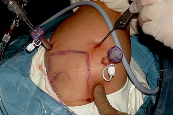 Bilateral Suprascapular Nerve Entrapment by Ganglion Cyst