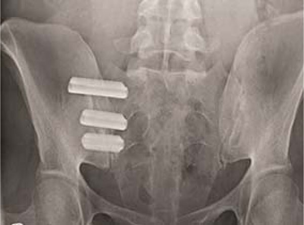 of Percutaneous Sacroiliac Joint Fixation with Porous Plasma