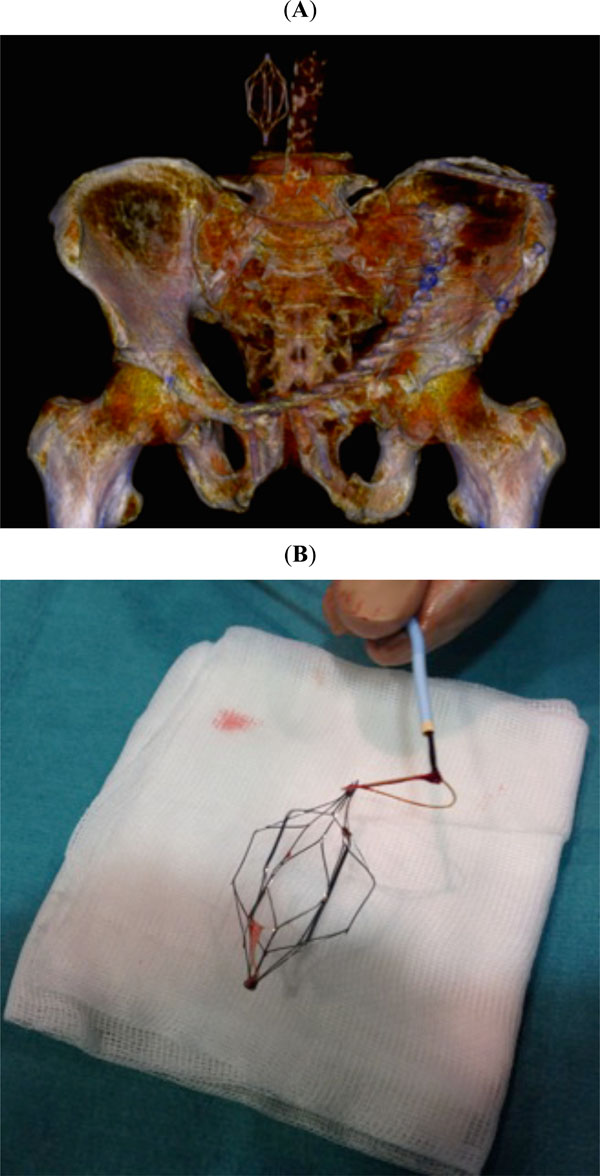 Methods and Guidelines for Venous Thromboembolism Prevention in