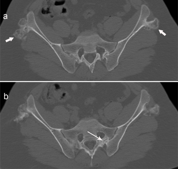 OsteochondromaRelated Pressure Erosions in Bony Rings Below the Waist