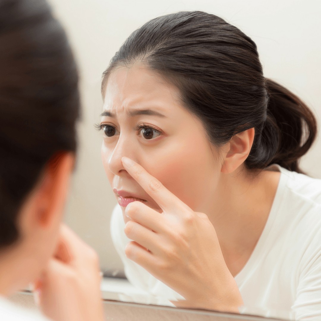 Natural Remedies for Acne During Pregnancy First Time Mom MN