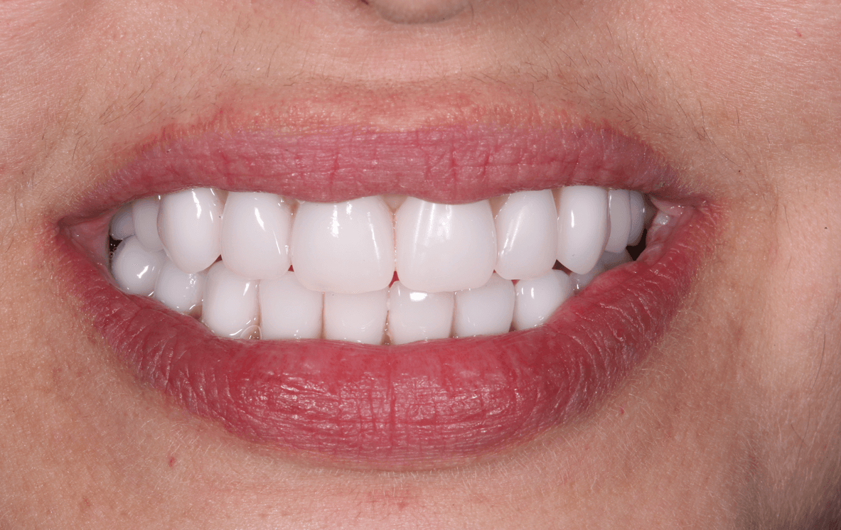 Lumineers Traditionally Thinner Veneers Bespoke Smile