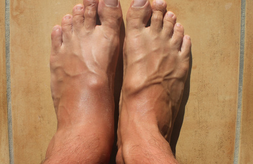 Geschwollene Knöchel und Füße Besser Gesund Leben