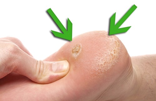 Hornhaut entfernen: Die besten Tipps und Hausmittel