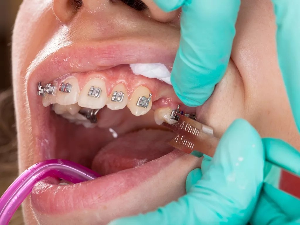 What is Orthodontics in Dubai? Best Dubai