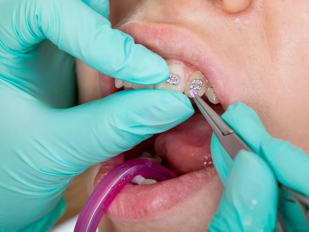 What is Orthodontics in Dubai? Best Dubai